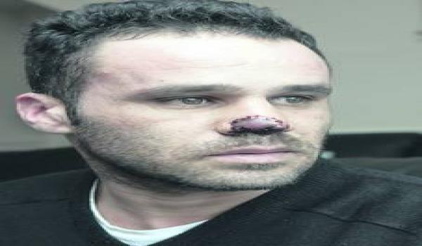 اكل لحوم بشرية يهاجم جزائريا ويقطم أذنه وأنفه في منطقة لندن ديري بإيرلندا الشمالية