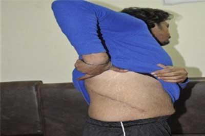 نازح عراقي اضطر لبيع كليته لسد رمق أطفاله